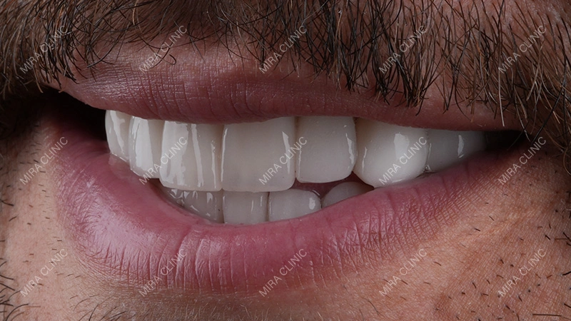 Hollywood Smile procedures